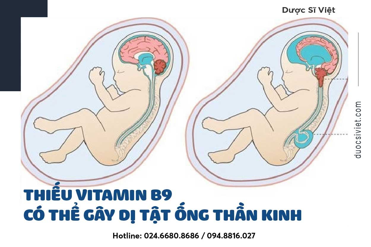 Thiếu vitamin B9 có thể gây dị tật ống thần kinh