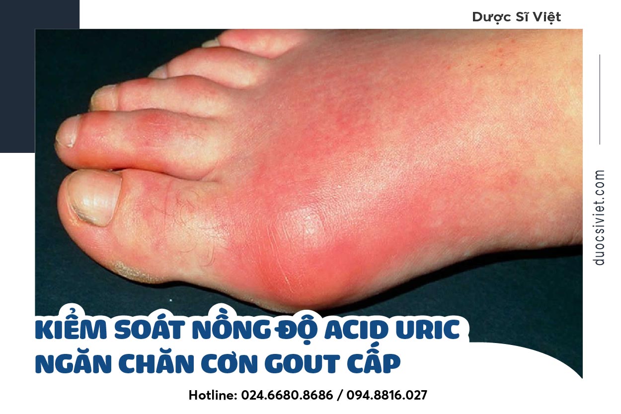 Kiểm soát nồng độ acid uric ngăn chặn cơn Gout cấp
