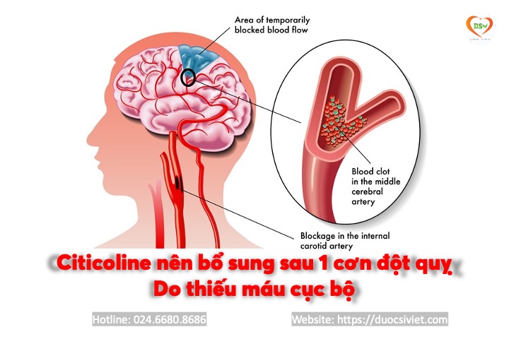 đột quỵ thiếu máu cục bộ 