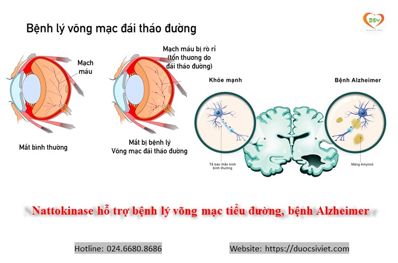 Nattokinae - hỗ trợ bệnh lý võng mạc tiểu đường, bệnh Alzheimer