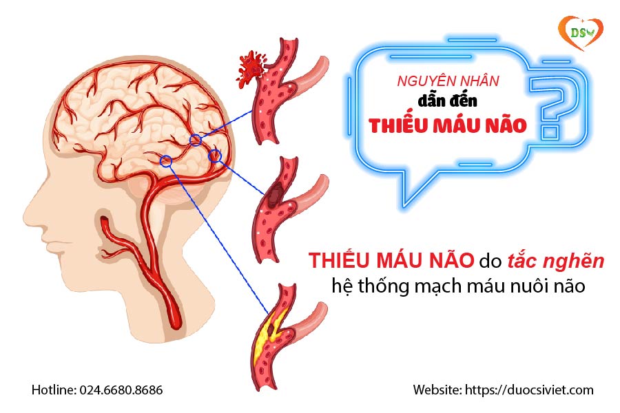 THIẾU MÁU NÃO do tắc nghẽn hệ thống mạch máu nuôi não