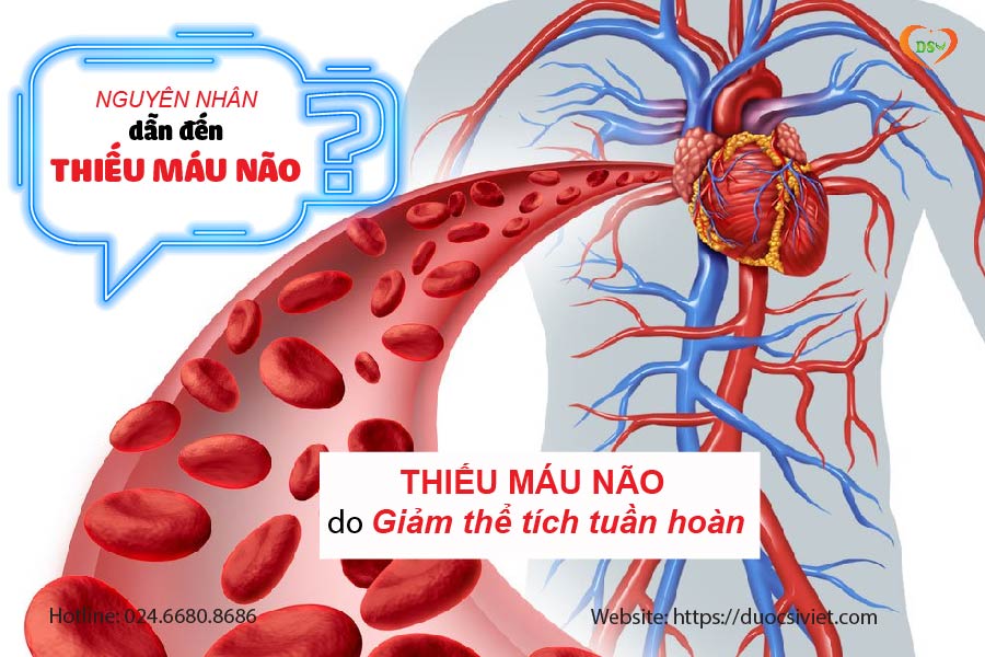 THIẾU MÁU NÃO do Giảm thể tích tuần hoàn