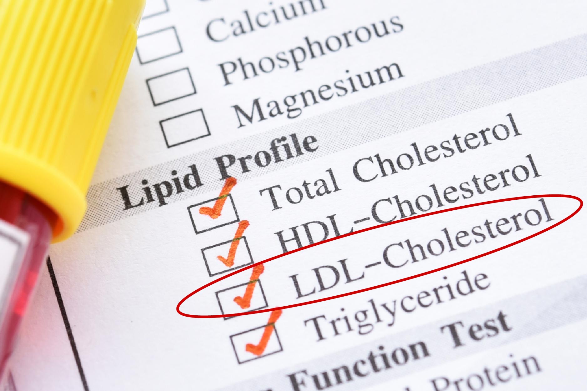 Các thông số mỡ máu chính khi xét nghiệm máu
