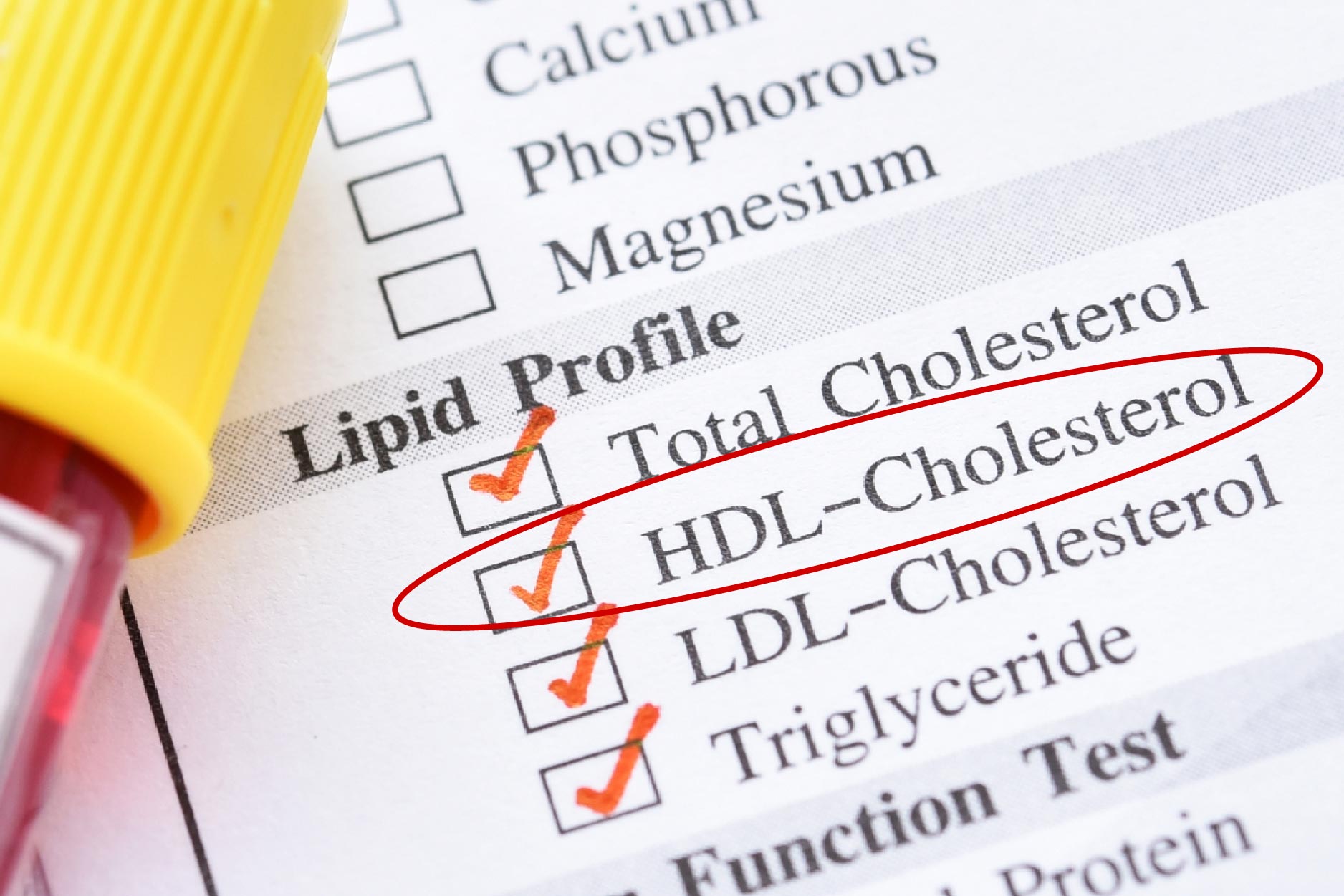 Các thông số mỡ máu chính khi xét nghiệm máu
