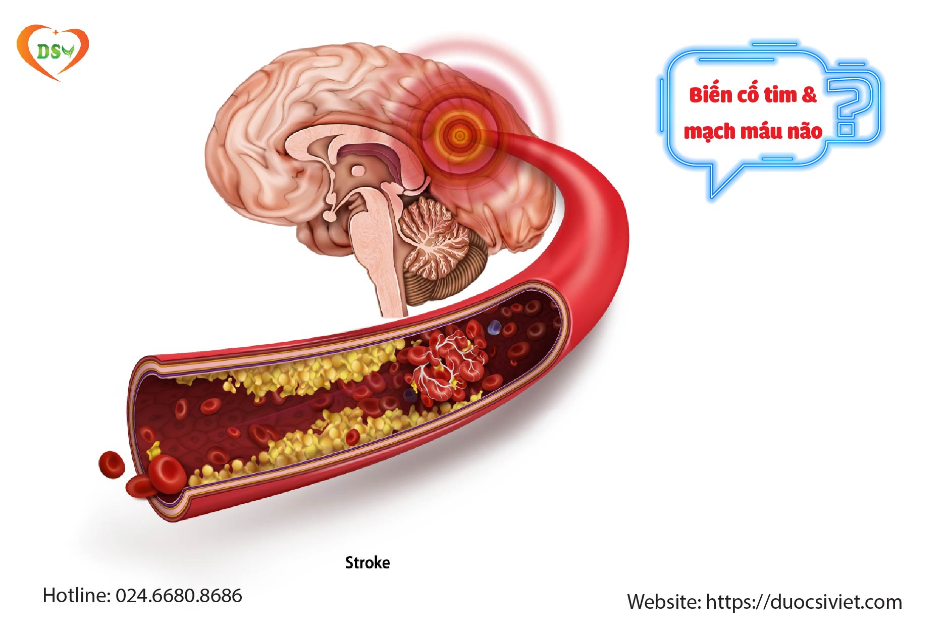 Tại sao tăng cholesterol thời gian dài lại xấu