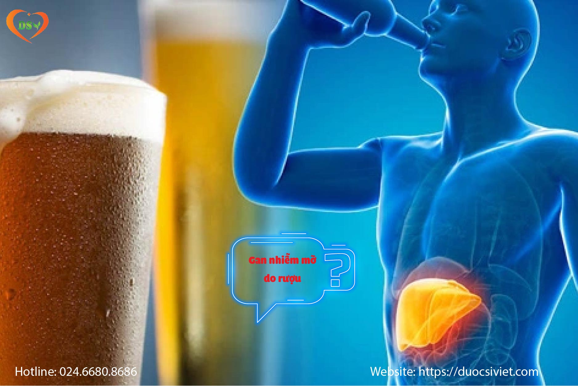 Gan nhiễm mỡ do rượu (Alcoholic Fatty Liver Disease - AFLD)