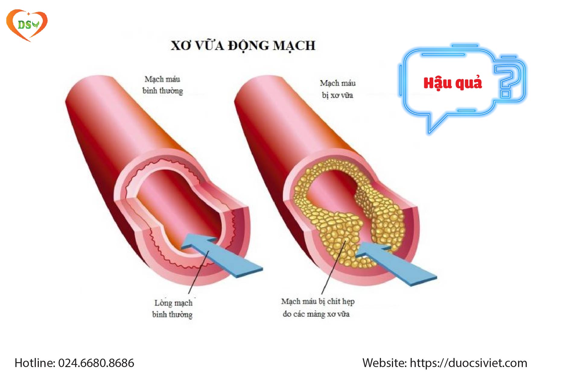Tại sao tăng cholesterol thời gian dài lại xấu
