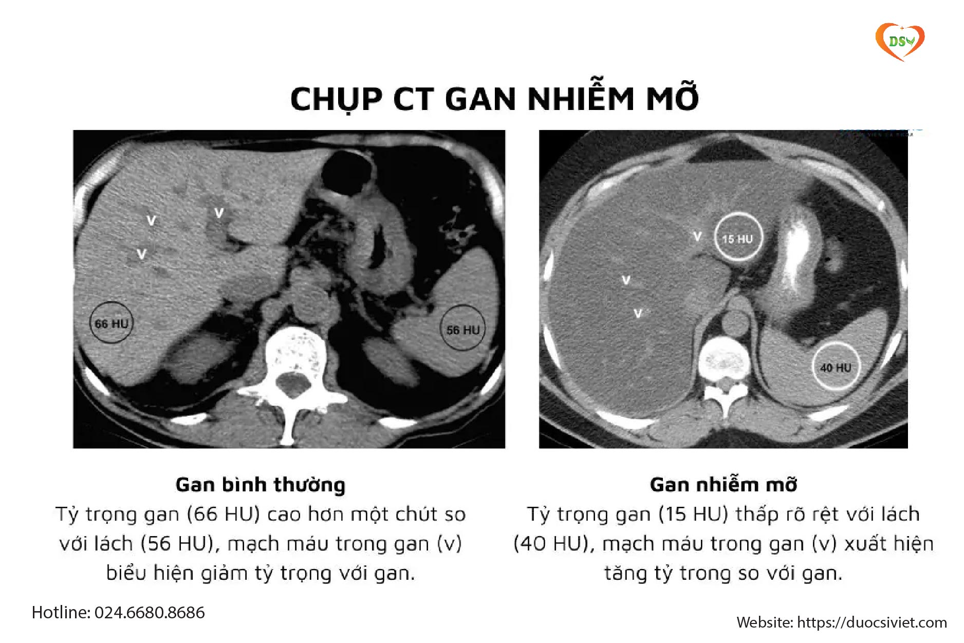 Chẩn đoán gan nhiễm mỡ