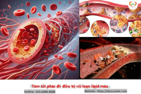 Tóm tắt phác đồ điều trị rối loạn lipid máu