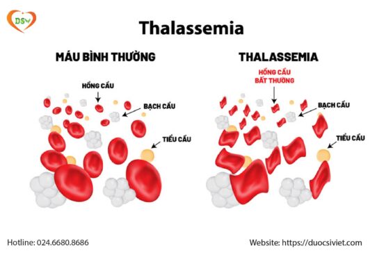 Tại sao bệnh nhân Thalasemia không bổ sung sắt