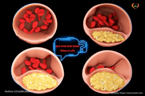Tại sao tăng cholesterol thời gian dài lại xấu