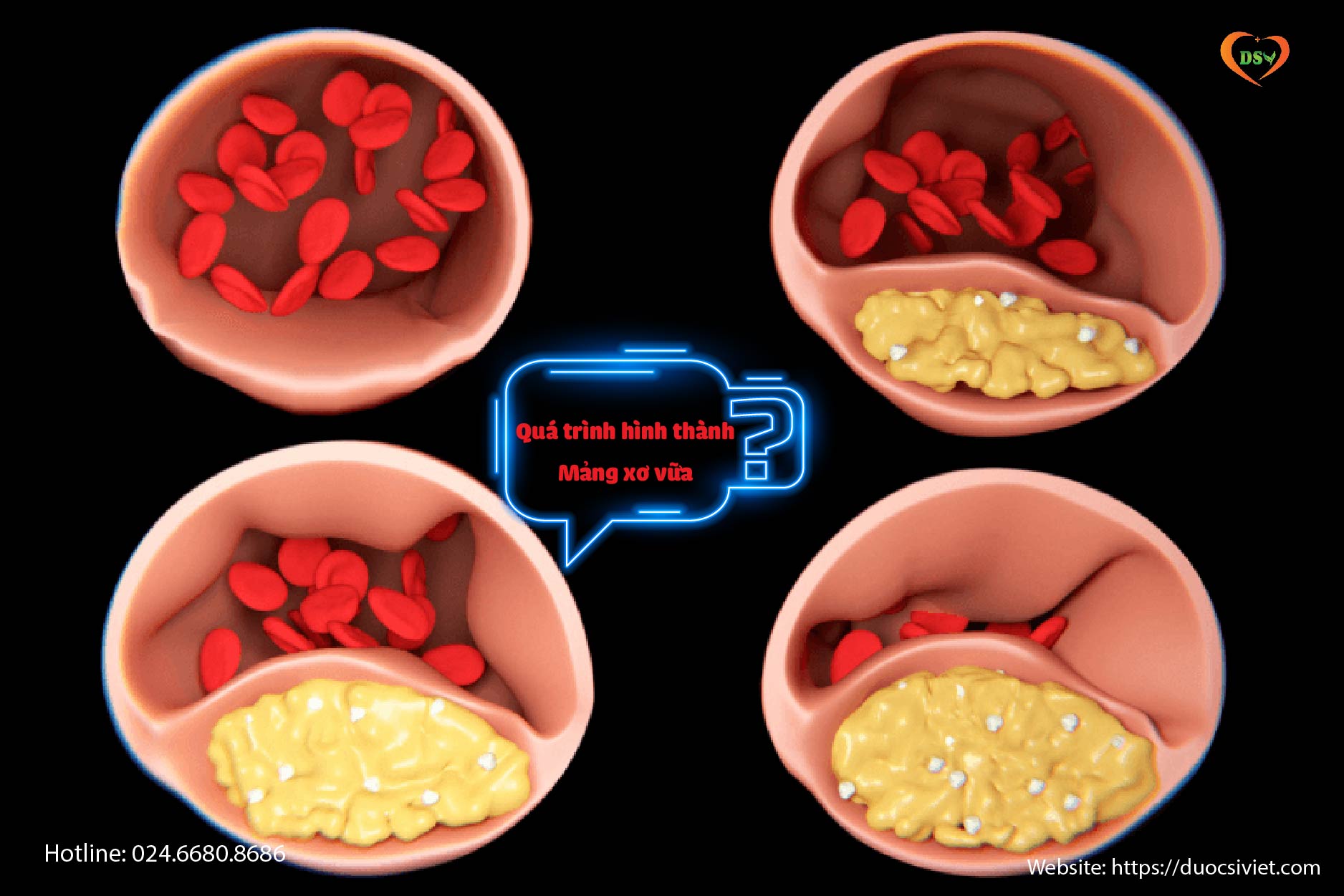 Tại sao tăng cholesterol thời gian dài lại xấu