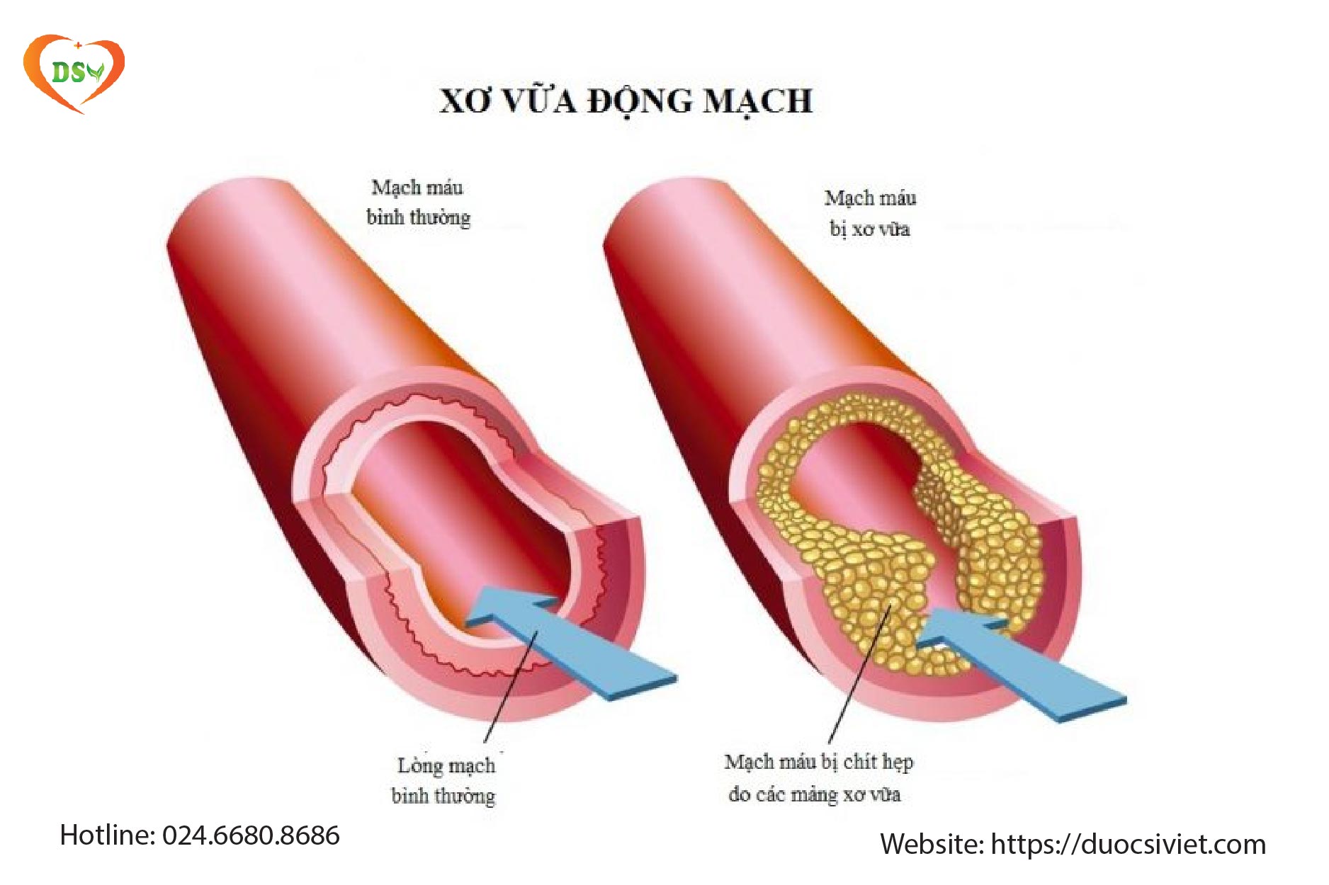 Xơ vữa động mạch